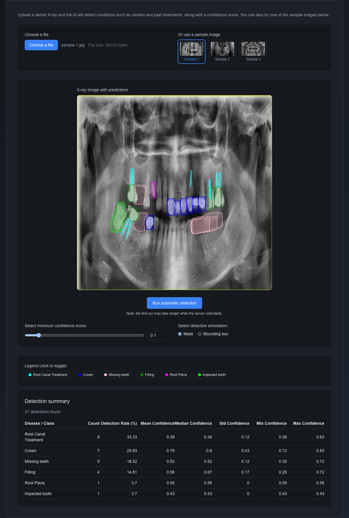 The Dentiscope detection results: findings such as root canal treatment, crowns, missing teeth and fillings overlaid in colors on the X-ray of Sample 1, with a detection summary table below