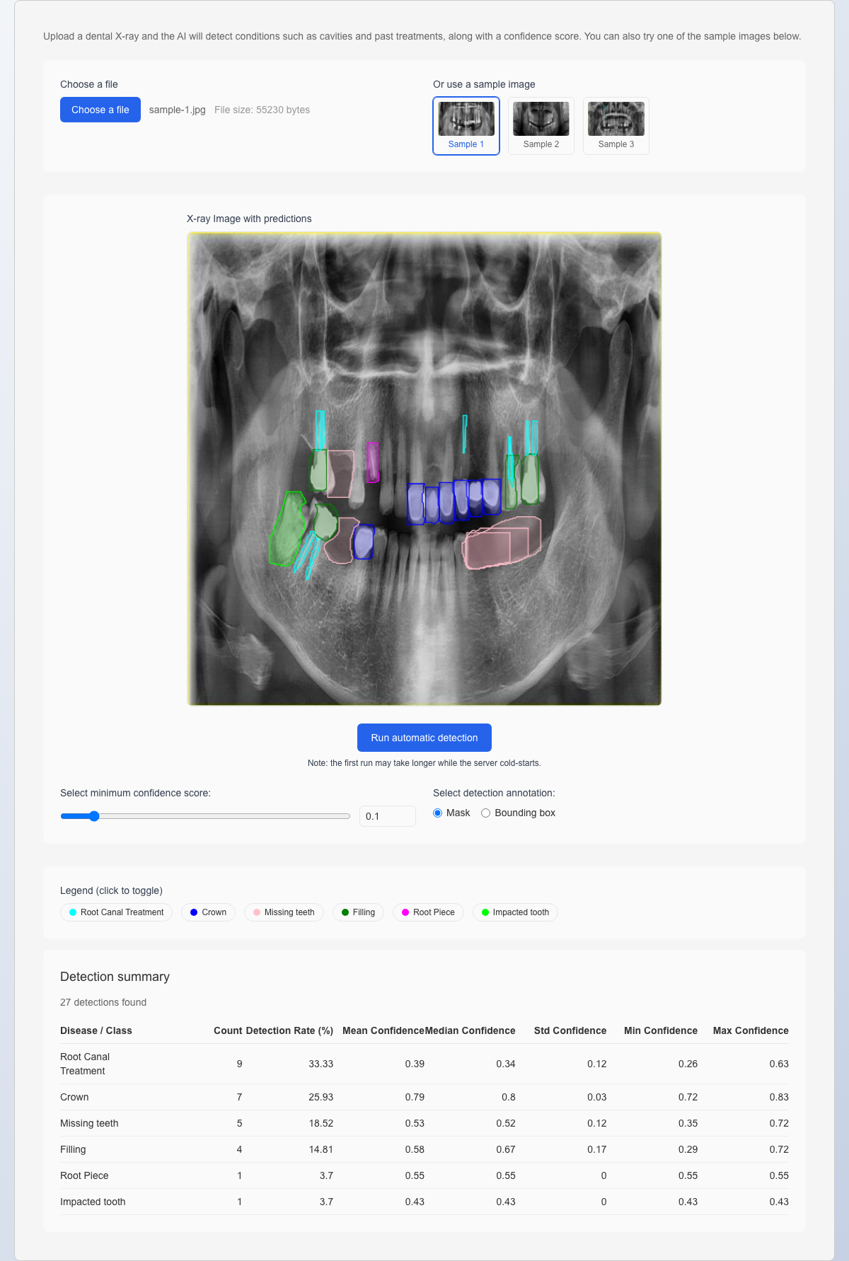 The Dentiscope detection results: findings such as root canal treatment, crowns, missing teeth and fillings overlaid in colors on the X-ray of Sample 1, with a detection summary table below