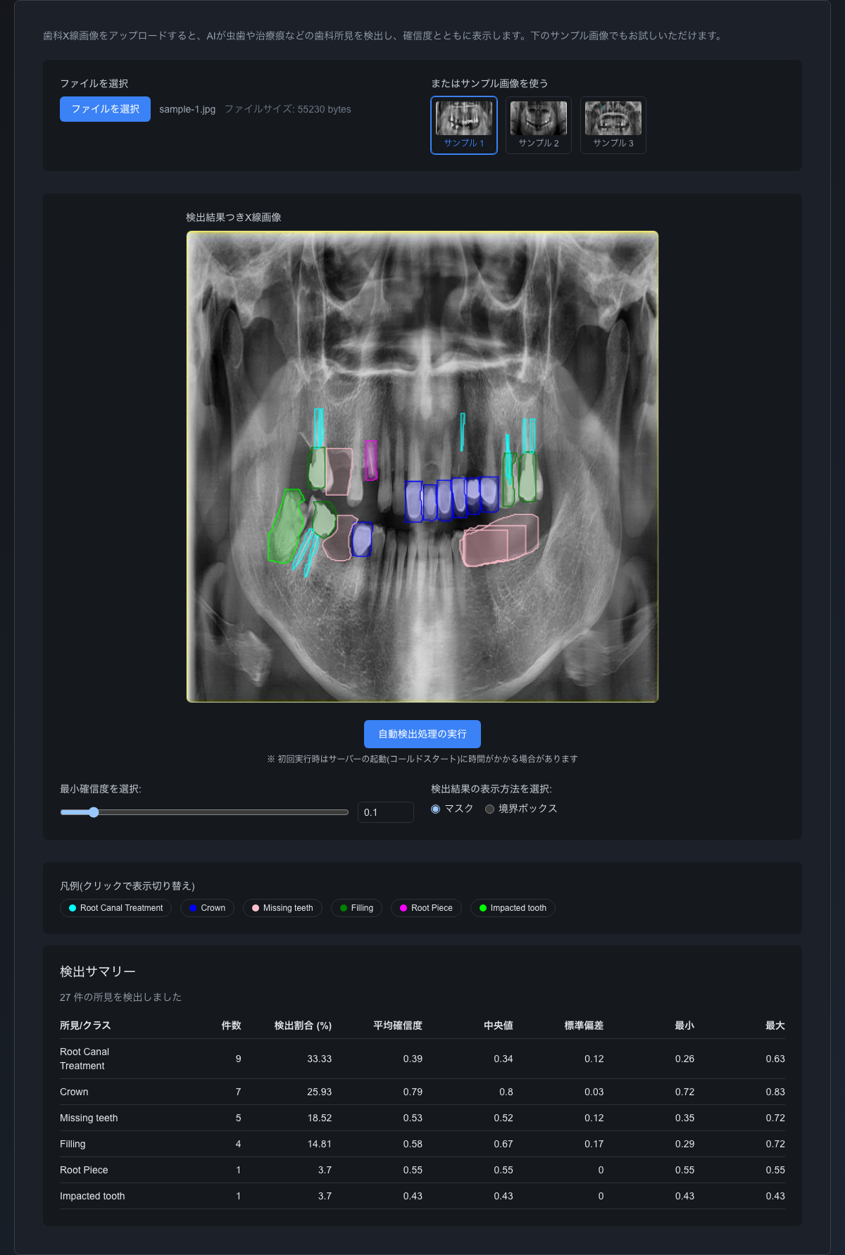 Dentiscope の検出結果の画面。サンプル1のX線画像に、根管治療・クラウン・欠損歯・詰め物などの所見が色分けして重ねて表示され、下に検出サマリーの表が並んでいる