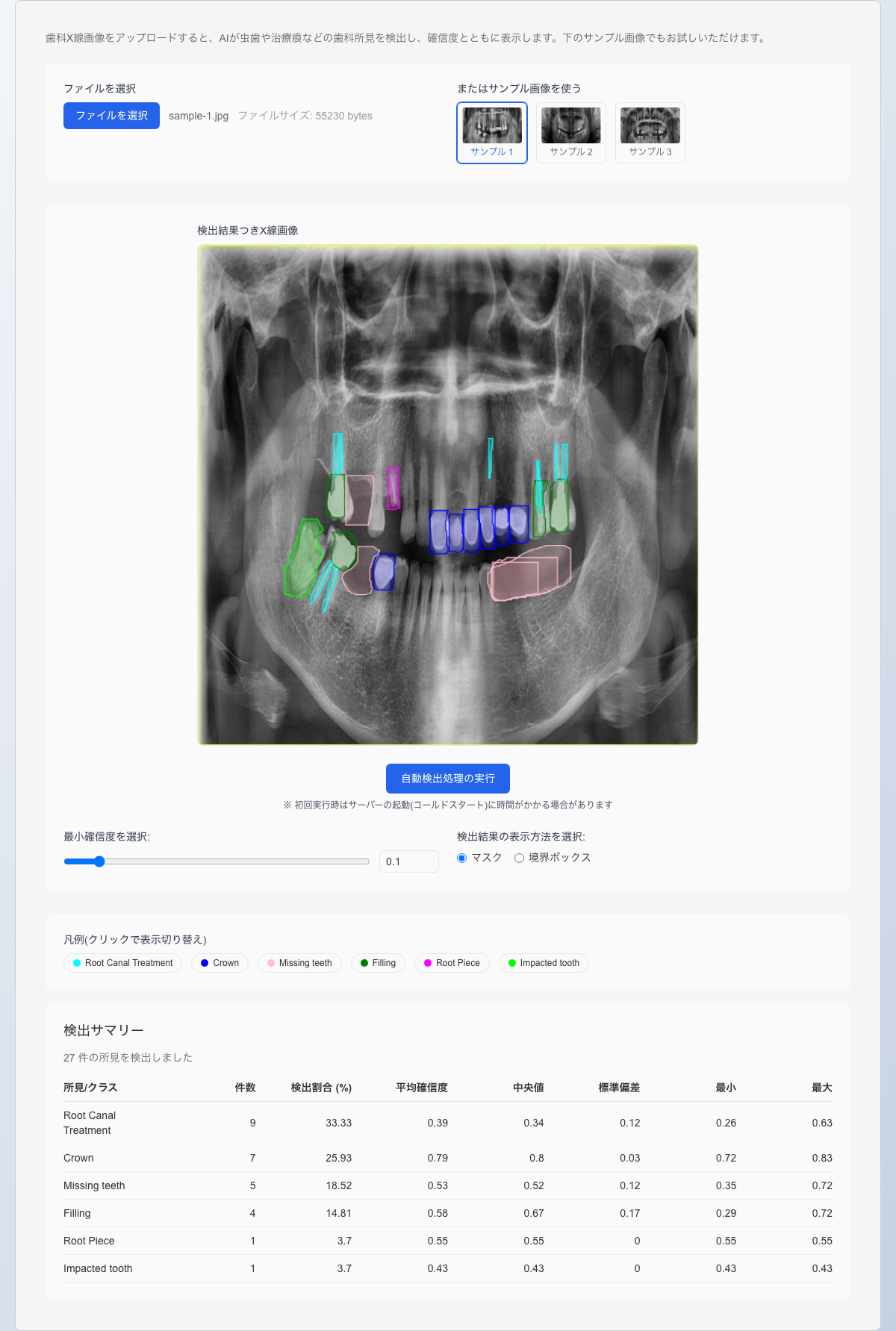 Dentiscope の検出結果の画面。サンプル1のX線画像に、根管治療・クラウン・欠損歯・詰め物などの所見が色分けして重ねて表示され、下に検出サマリーの表が並んでいる